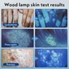 Phototherapy Woods Lamp Melasma Lamp Skin Examination Skin Fungus Detector for Vitiligo Pityriasis Versicolor - Image 5